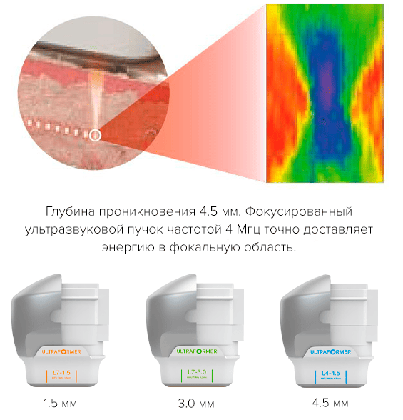 ultraformer technology