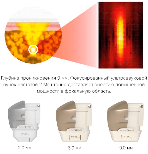 ultraformer technology