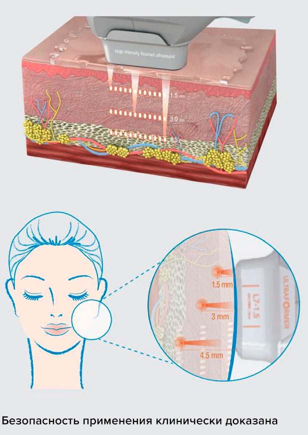 ultraformer using