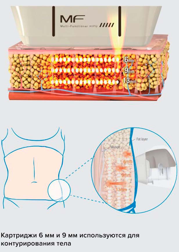 ultraformer using
