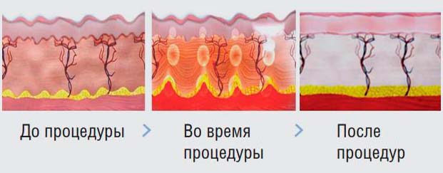 ultraformer using